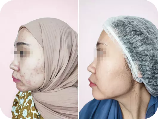 klinik jerawat surabaya