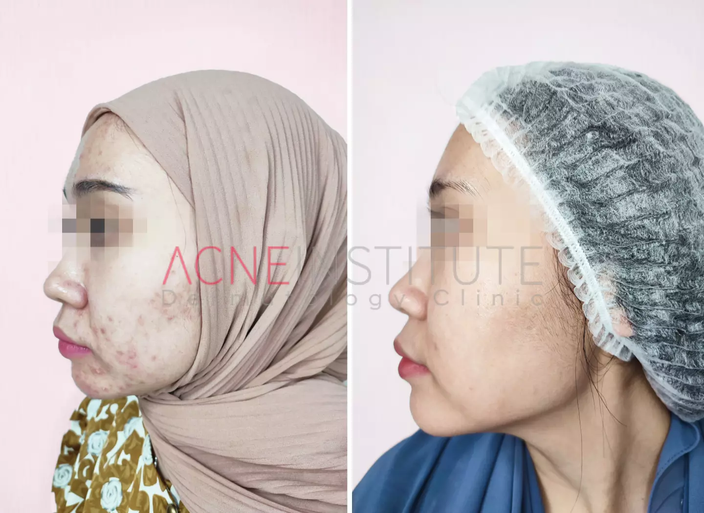 treatment jerawat