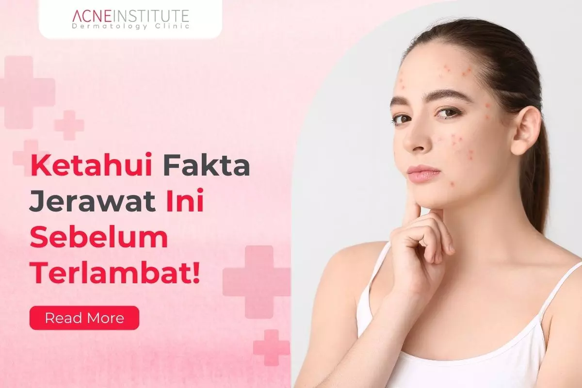Ketahui Fakta Jerawat Ini Sebelum Terlambat!