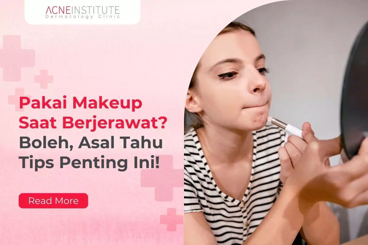 Pakai Makeup Saat Berjerawat? Boleh, Asal Tahu Tips Penting Ini!
