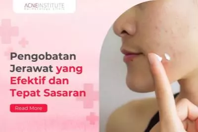 Pengobatan Jerawat yang Efektif dan Tepat Sasaran