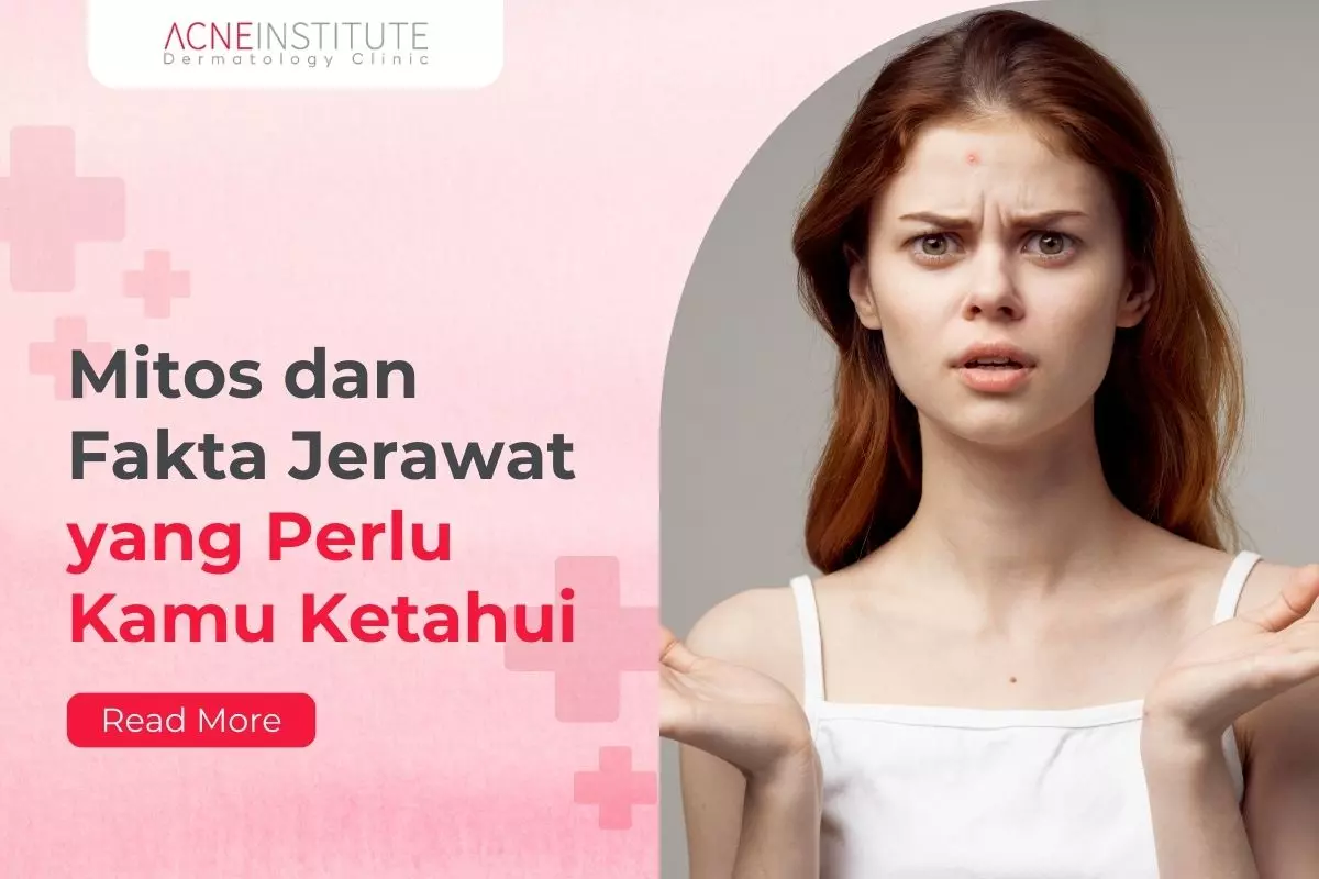 Mitos dan Fakta Jerawat yang Perlu Kamu Ketahui