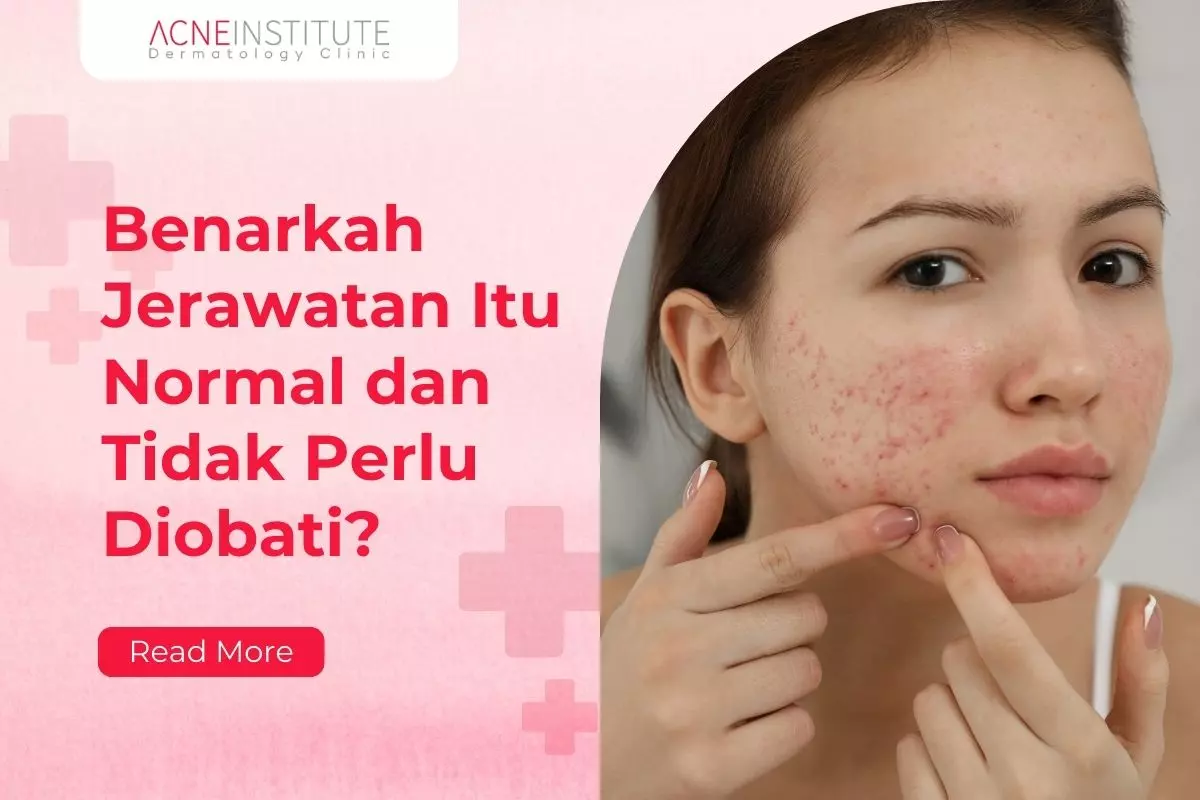 Benarkah Jerawatan Itu Normal dan Tidak Perlu Diobati?