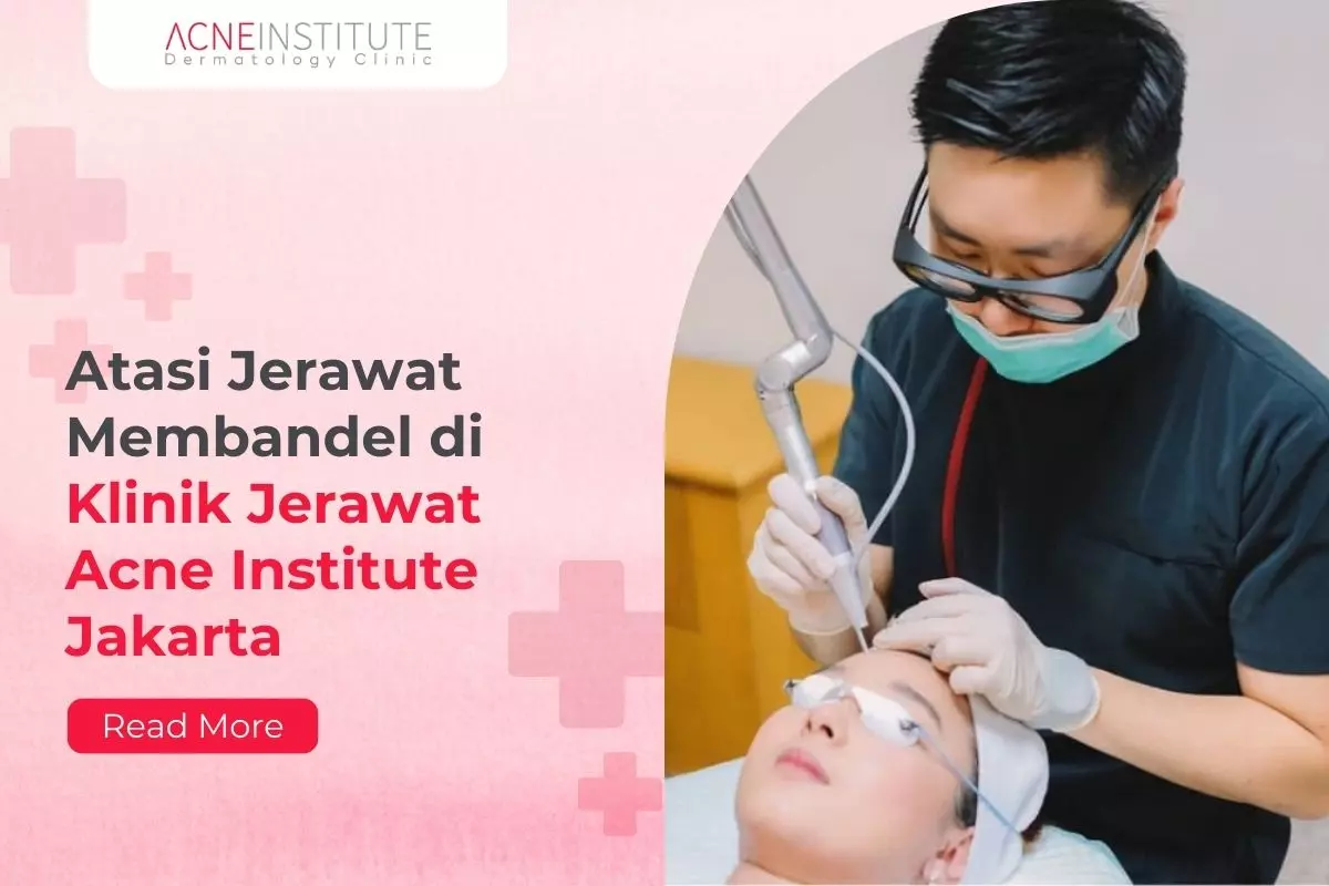 Atasi Jerawat Membandel di Klinik Jerawat Acne Institute Jakarta