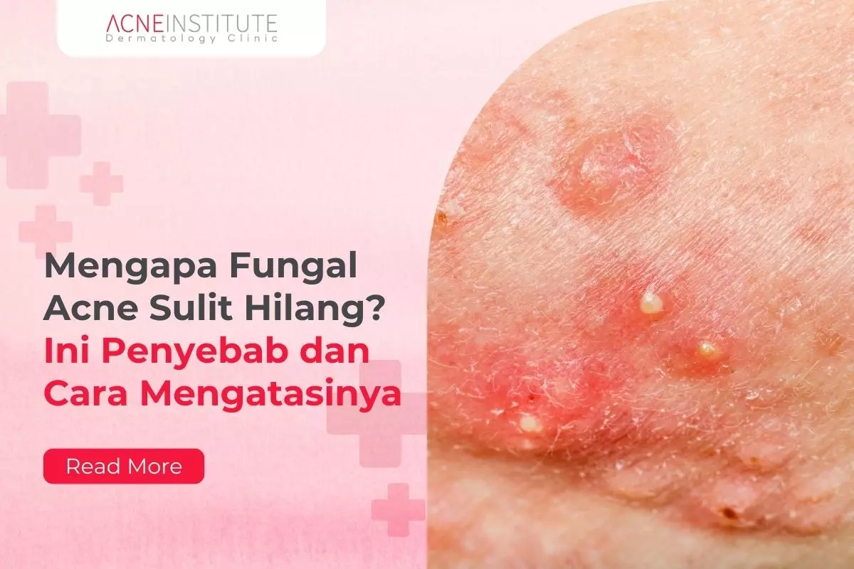 Mengapa Fungal Acne Sulit Hilang? Ini Penyebab dan Cara Mengatasinya