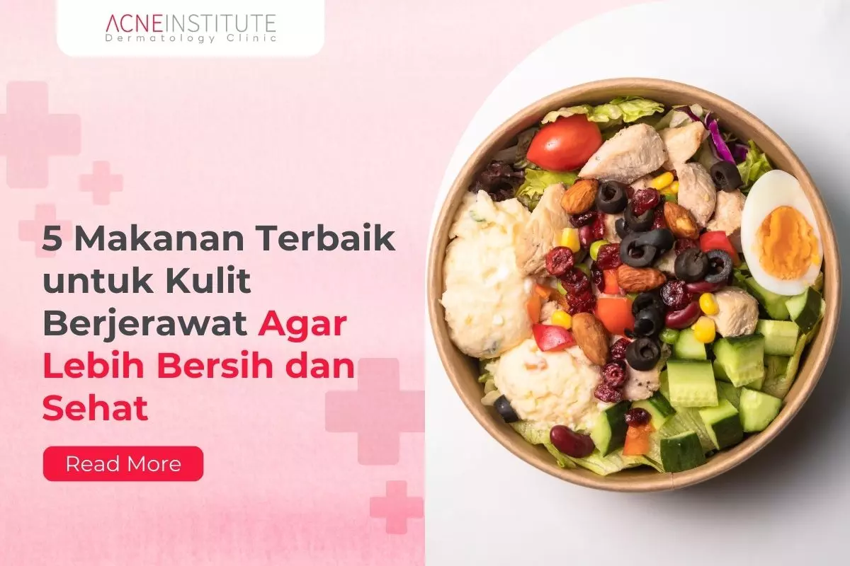 5 Makanan Terbaik untuk Kulit Berjerawat Agar Lebih Bersih dan Sehat