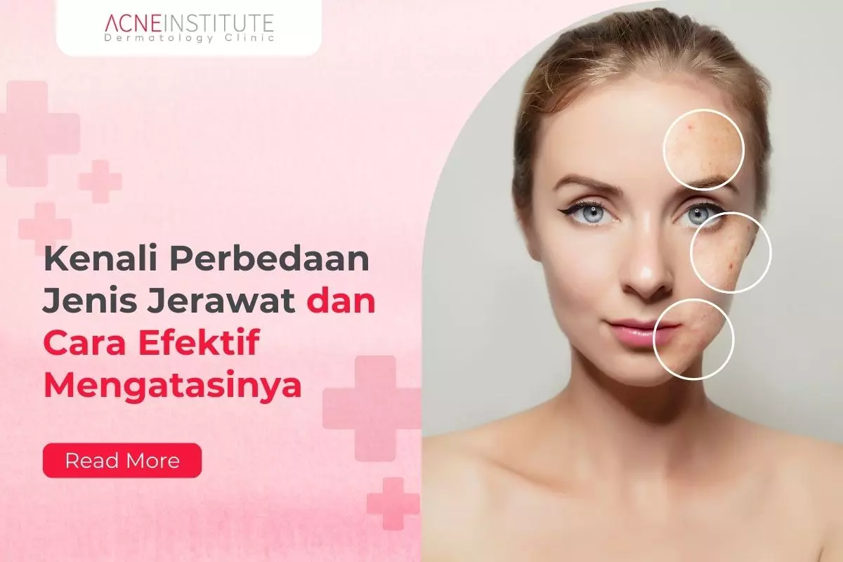 Kenali Perbedaan Jenis Jerawat dan Cara Efektif Mengatasinya
