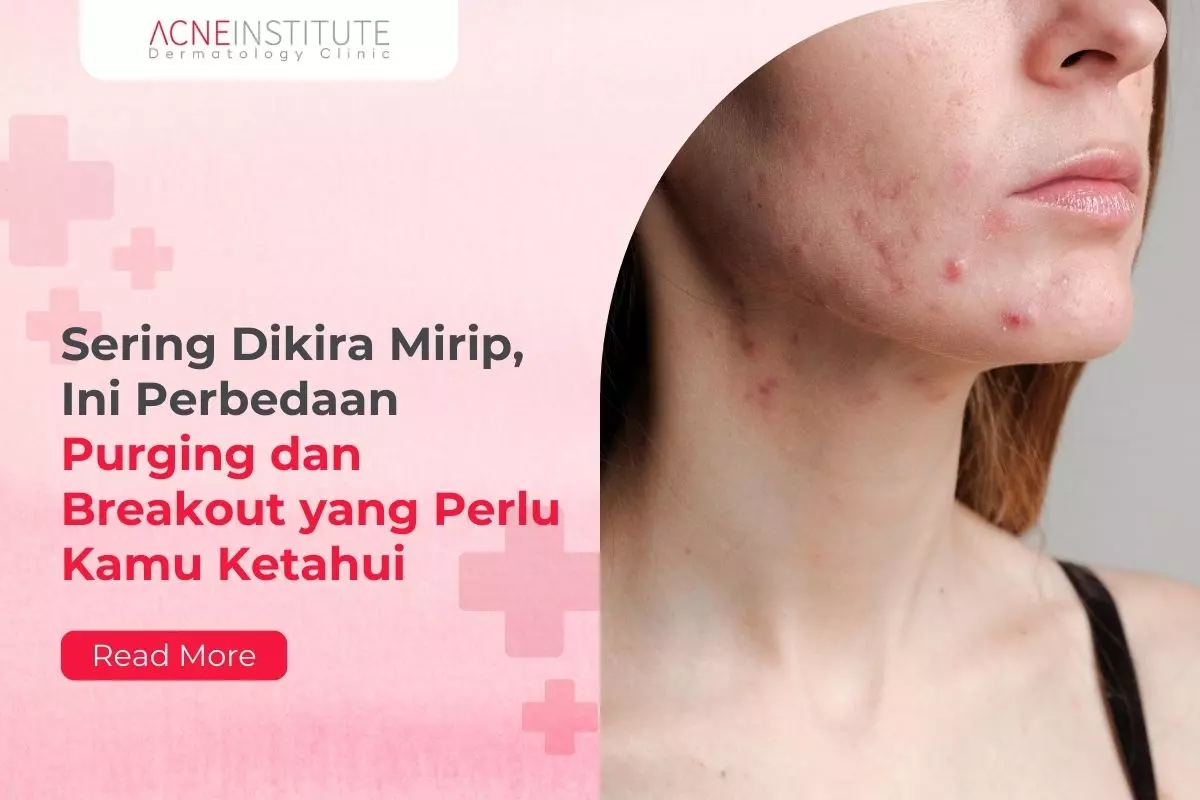 Sering Dikira Mirip, Ini Perbedaan Purging dan Breakout yang Perlu Kamu Ketahui