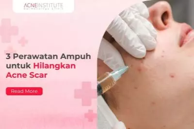 3 Perawatan Ampuh untuk Hilangkan Acne Scar