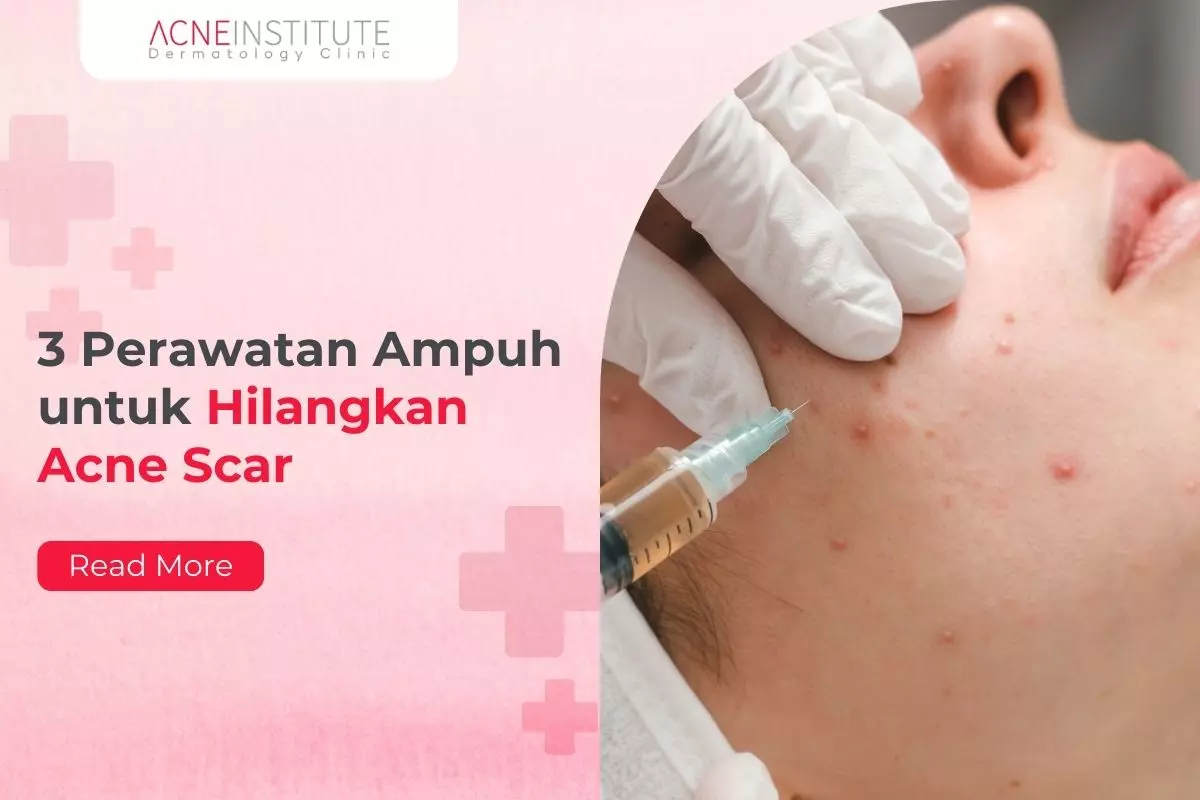 3 Perawatan Ampuh untuk Hilangkan Acne Scar