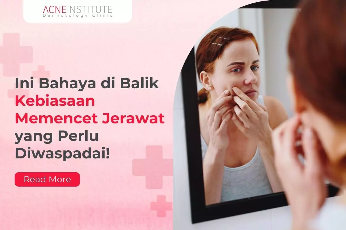 Ini Bahaya di Balik Kebiasaan Memencet Jerawat yang Perlu Diwaspadai!