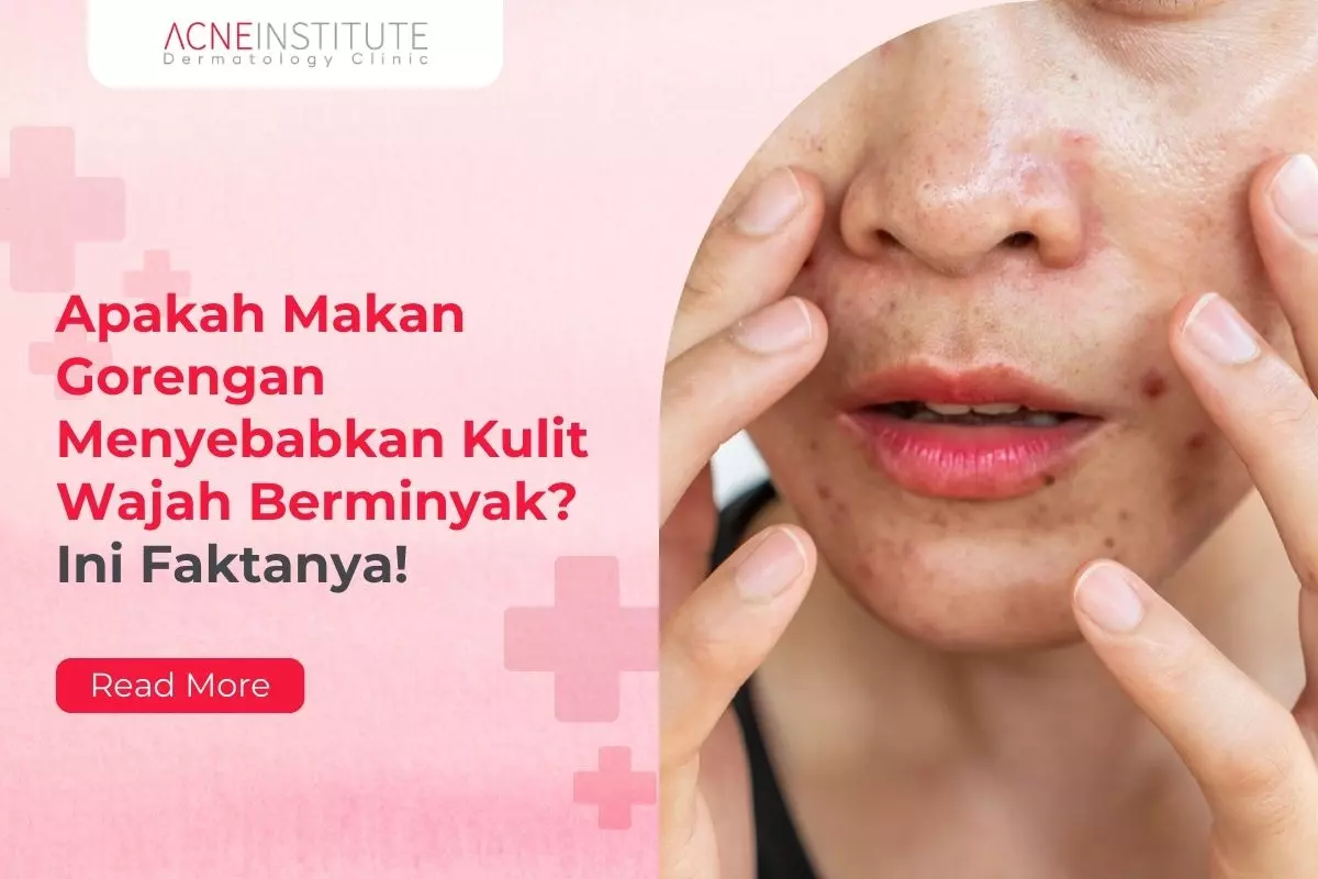 Apakah Makan Gorengan Menyebabkan Kulit Wajah Berminyak? Ini Faktanya
