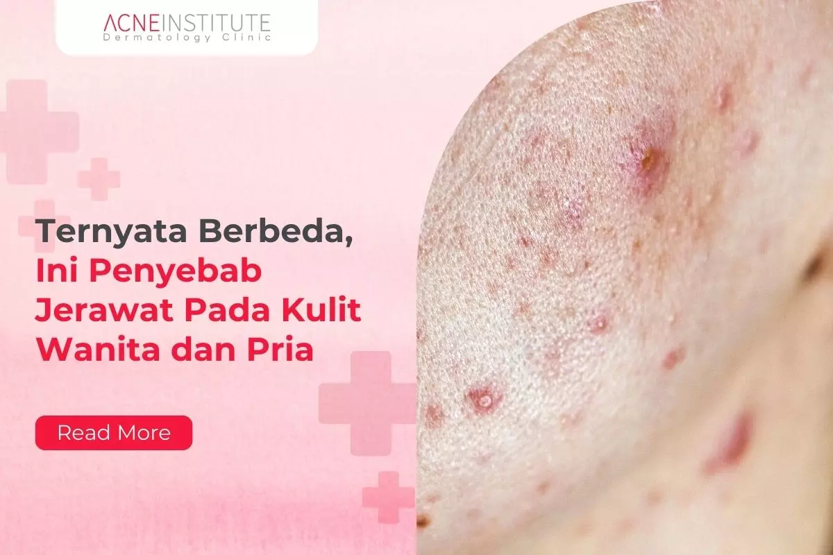 Ternyata Berbeda, Ini Penyebab Jerawat Pada Kulit Wanita dan Pria