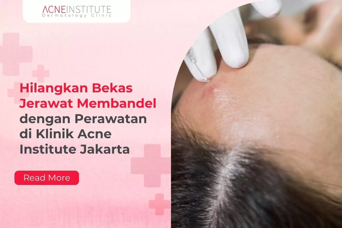 Hilangkan Bekas Jerawat Membandel dengan Perawatan di Klinik Acne Institute Jakarta