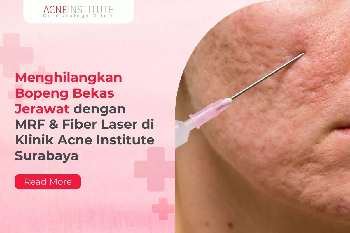 Menghilangkan Bopeng Bekas Jerawat dengan MRF & Fiber Laser di Klinik Acne Institute Surabaya