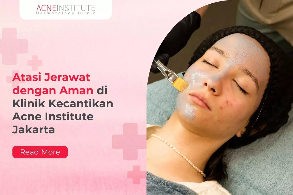 Atasi Jerawat dengan Aman di Klinik Kecantikan Acne Institute Jakarta