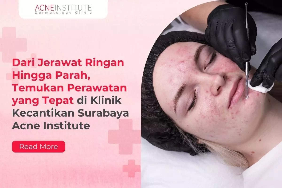 Dari Jerawat Ringan Hingga Parah, Temukan Perawatan yang Tepat di Klinik Kecantikan Surabaya Acne Institute