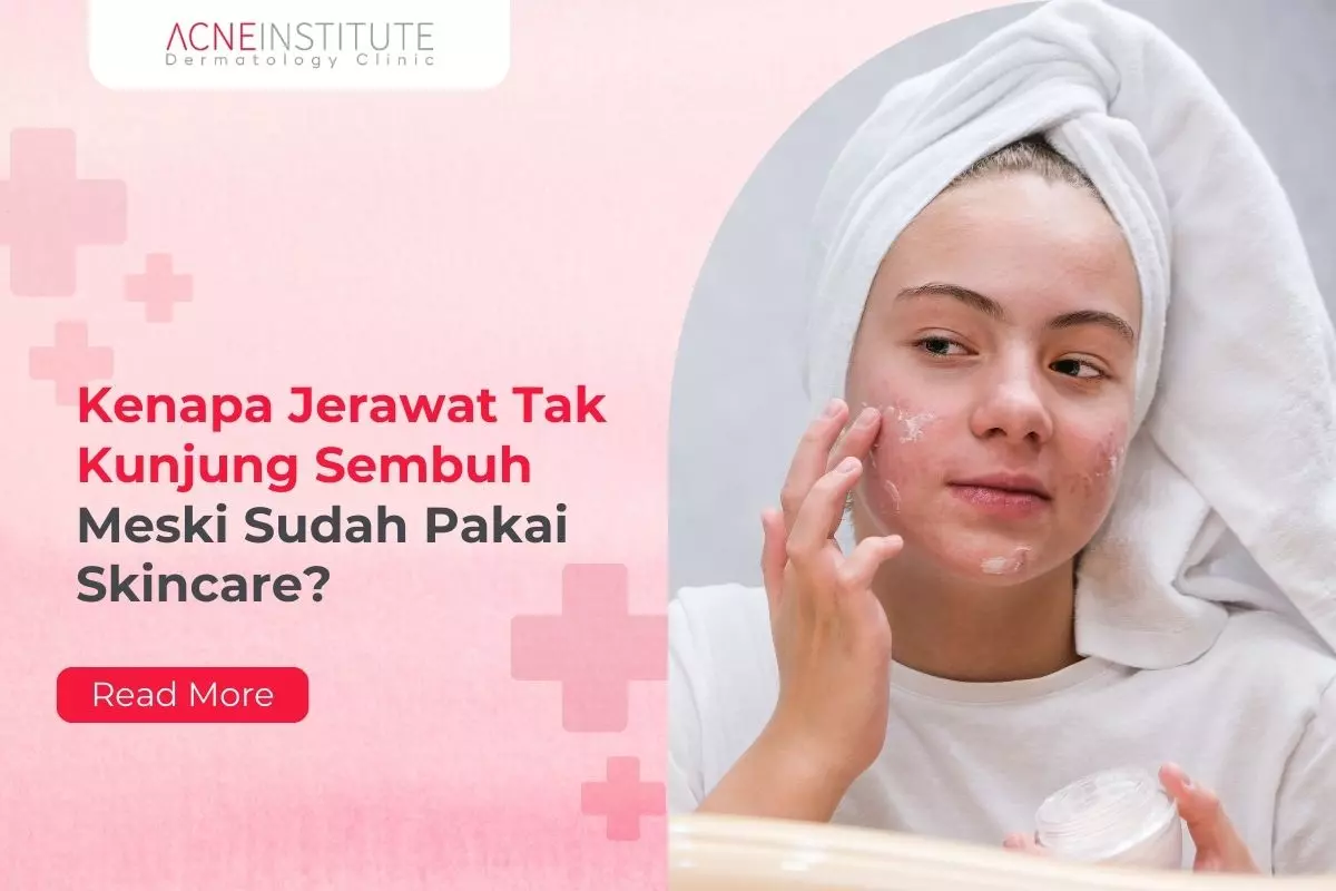 Kenapa Jerawat Tak Kunjung Sembuh Meski Sudah Pakai Skincare?