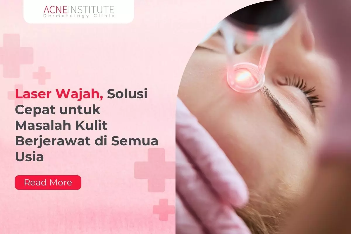 Laser Wajah, Solusi Cepat untuk Masalah Kulit Berjerawat di Semua Usia