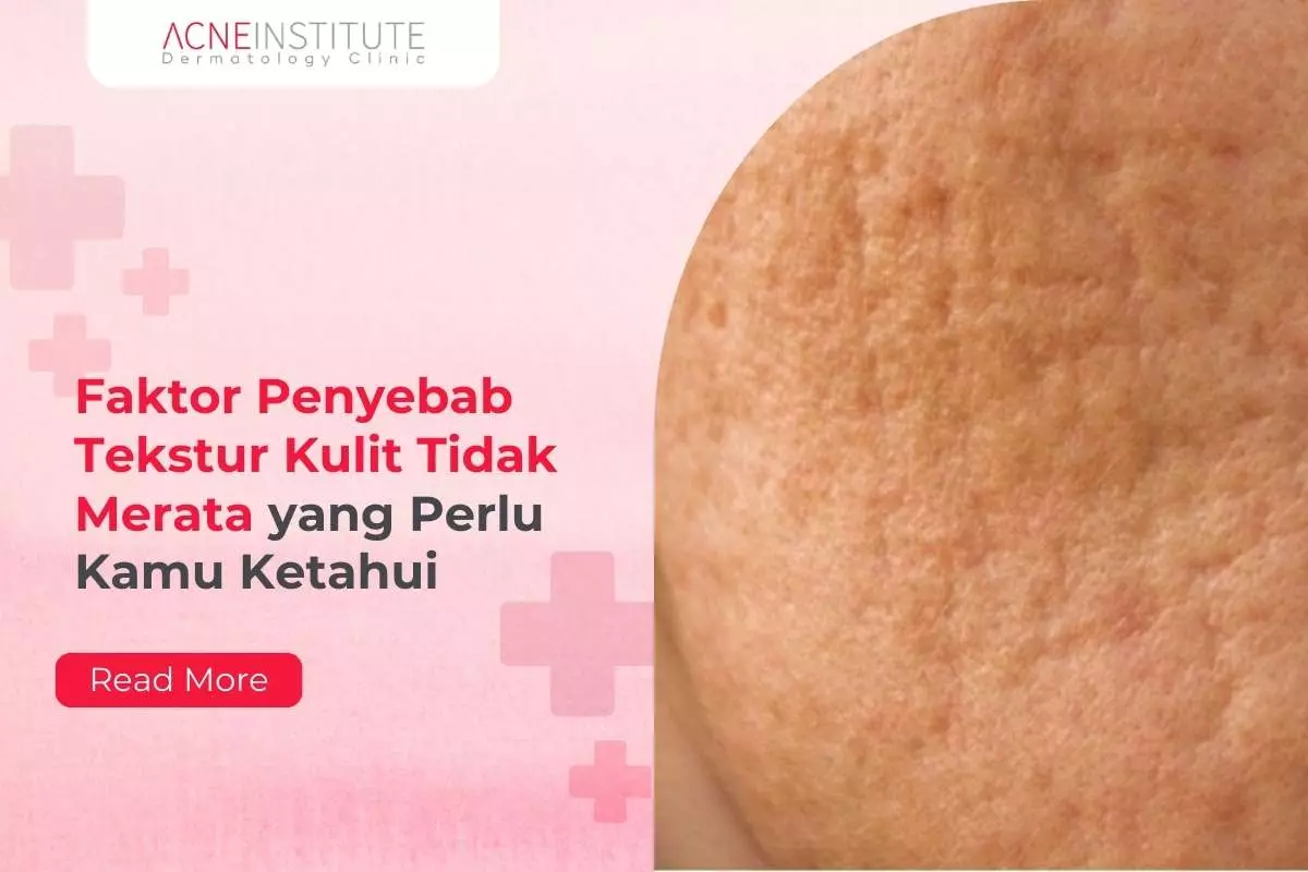 Faktor Penyebab Tekstur Kulit Tidak Merata yang Perlu Kamu Ketahui