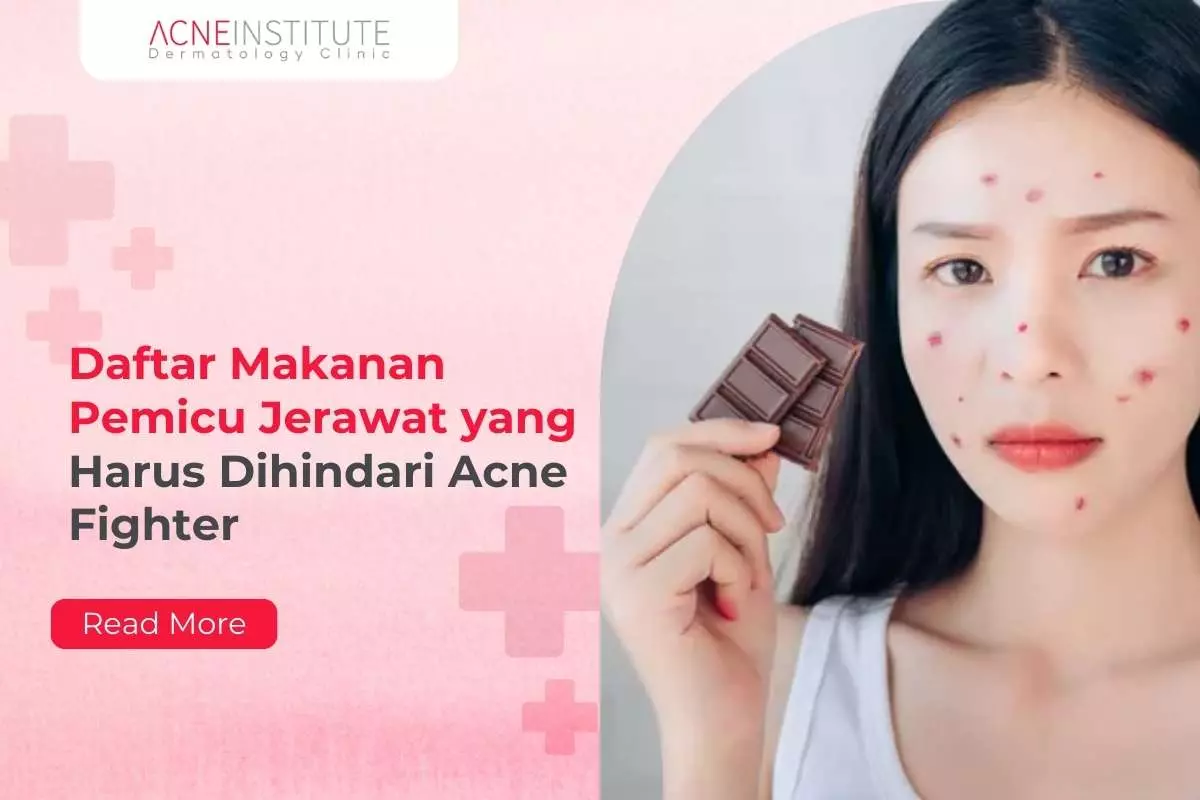 Daftar Makanan Pemicu Jerawat yang Harus Dihindari Acne Fighter