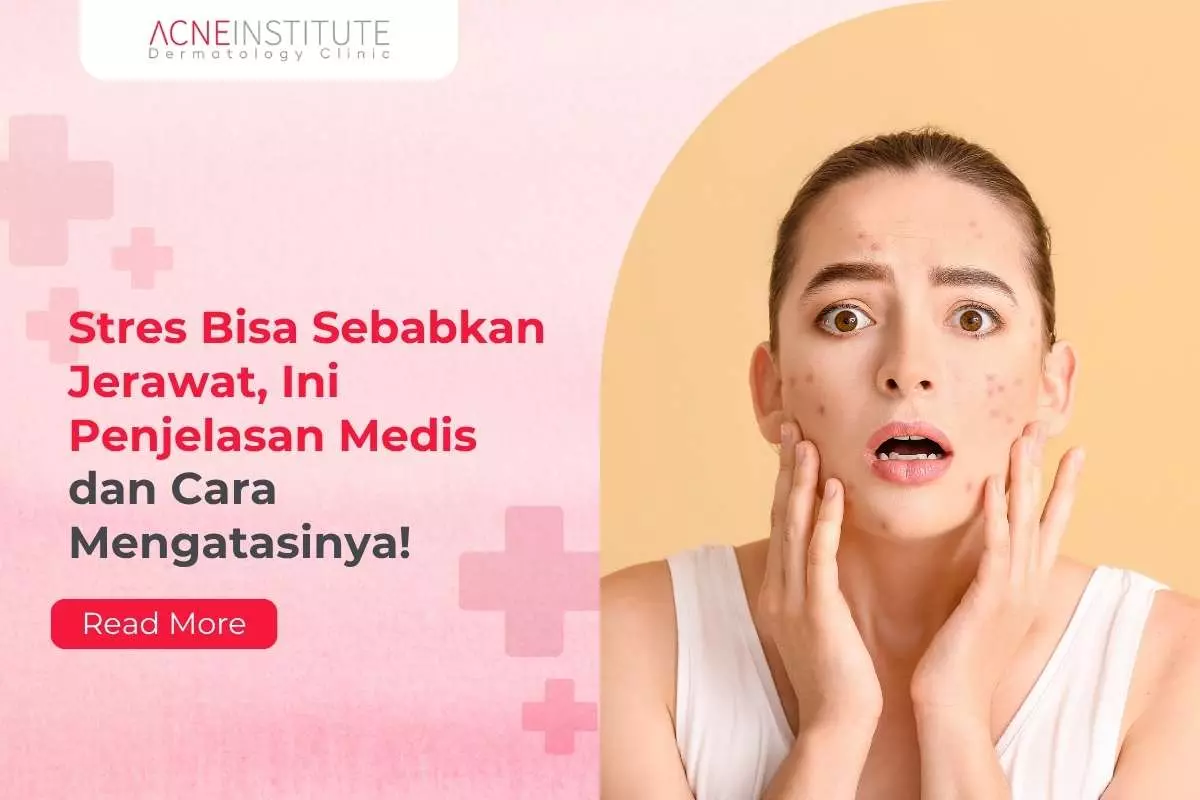 Stres Bisa Sebabkan Jerawat, Ini Penjelasan Medis dan Cara Mengatasinya!