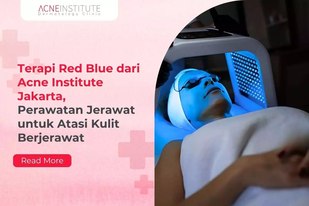 Terapi Red Blue dari Acne Institute Jakarta, Perawatan Jerawat untuk Atasi Kulit Berjerawat