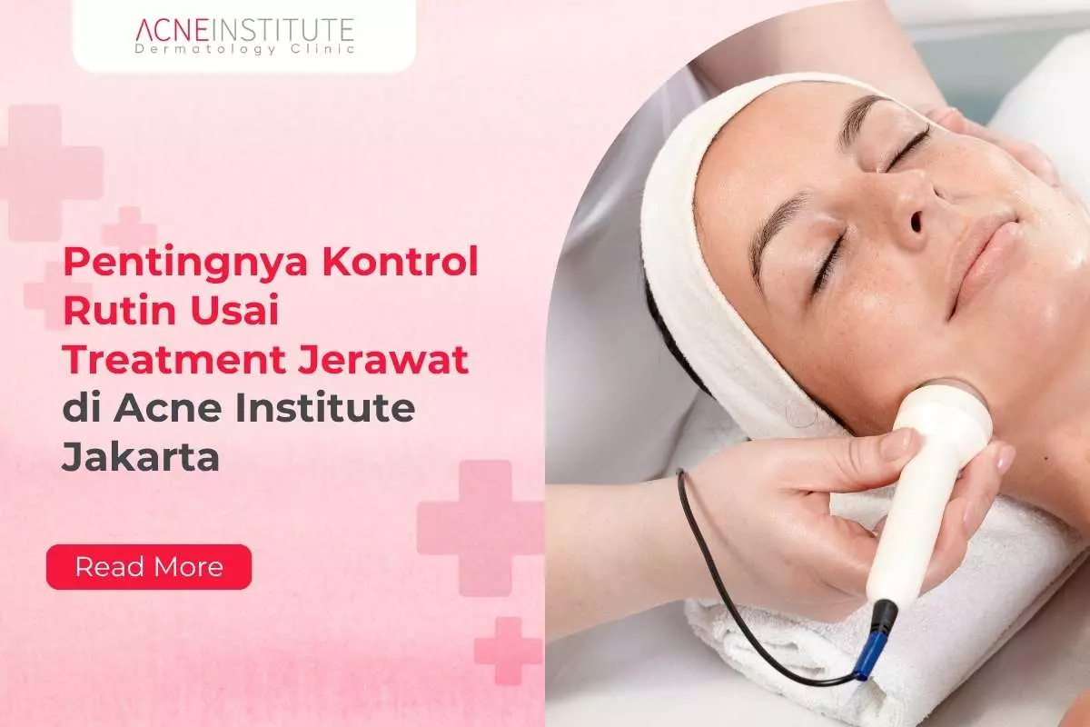 Pentingnya Kontrol Rutin Usai Treatment Jerawat di Acne Institute Jakarta