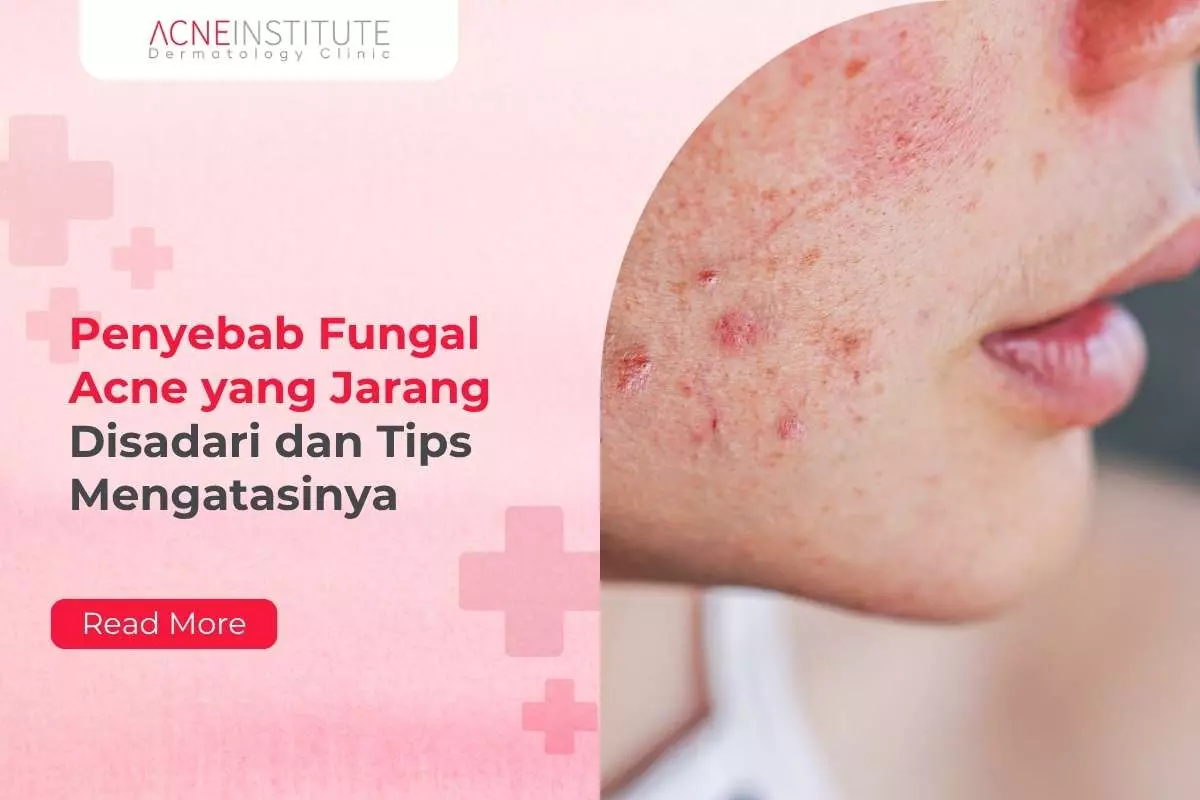 Penyebab Fungal Acne yang Jarang Disadari dan Tips Mengatasinya