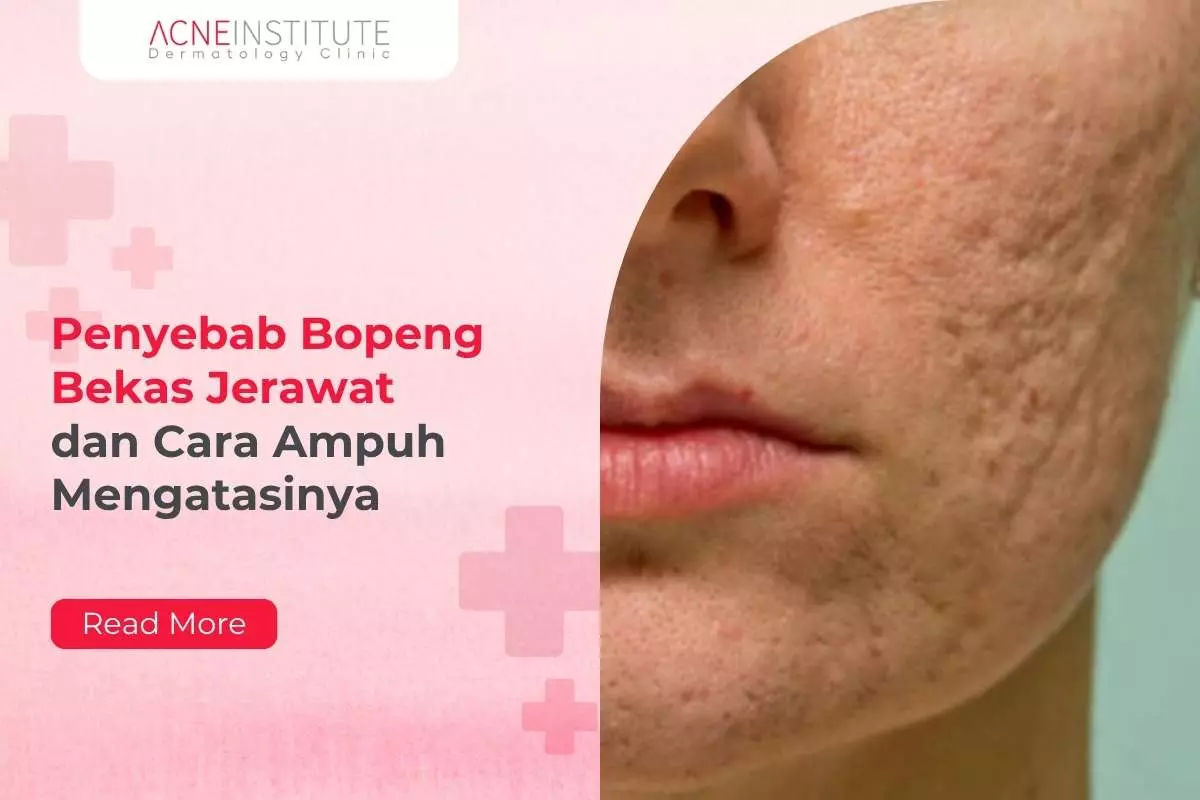 Penyebab Bopeng Bekas Jerawat dan Cara Ampuh Mengatasinya