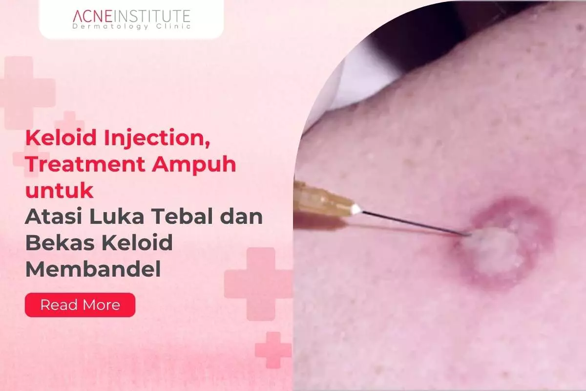 Keloid Injection, Treatment Ampuh untuk Atasi Luka Tebal dan Bekas Keloid Membandel
