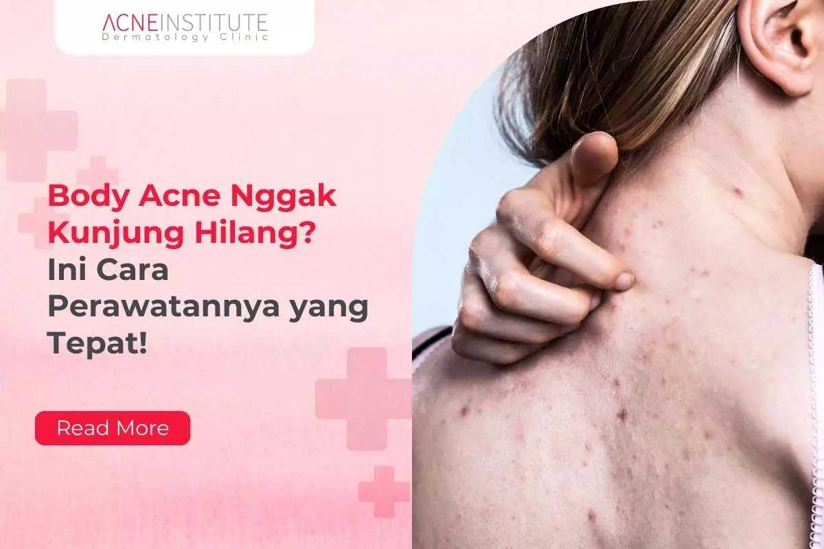 Body Acne Nggak Kunjung Hilang? Ini Cara Perawatannya yang Tepat!