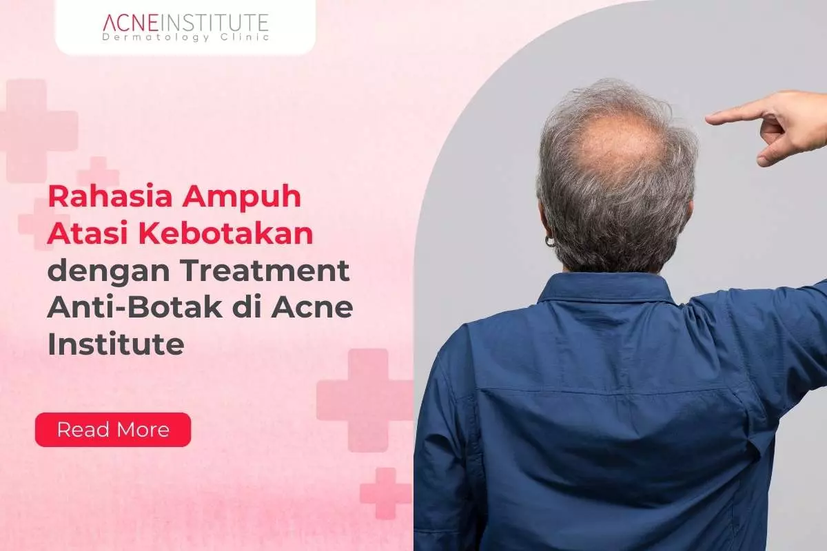 Rahasia Ampuh Atasi Kebotakan dengan Treatment Anti-Botak di Acne Institute