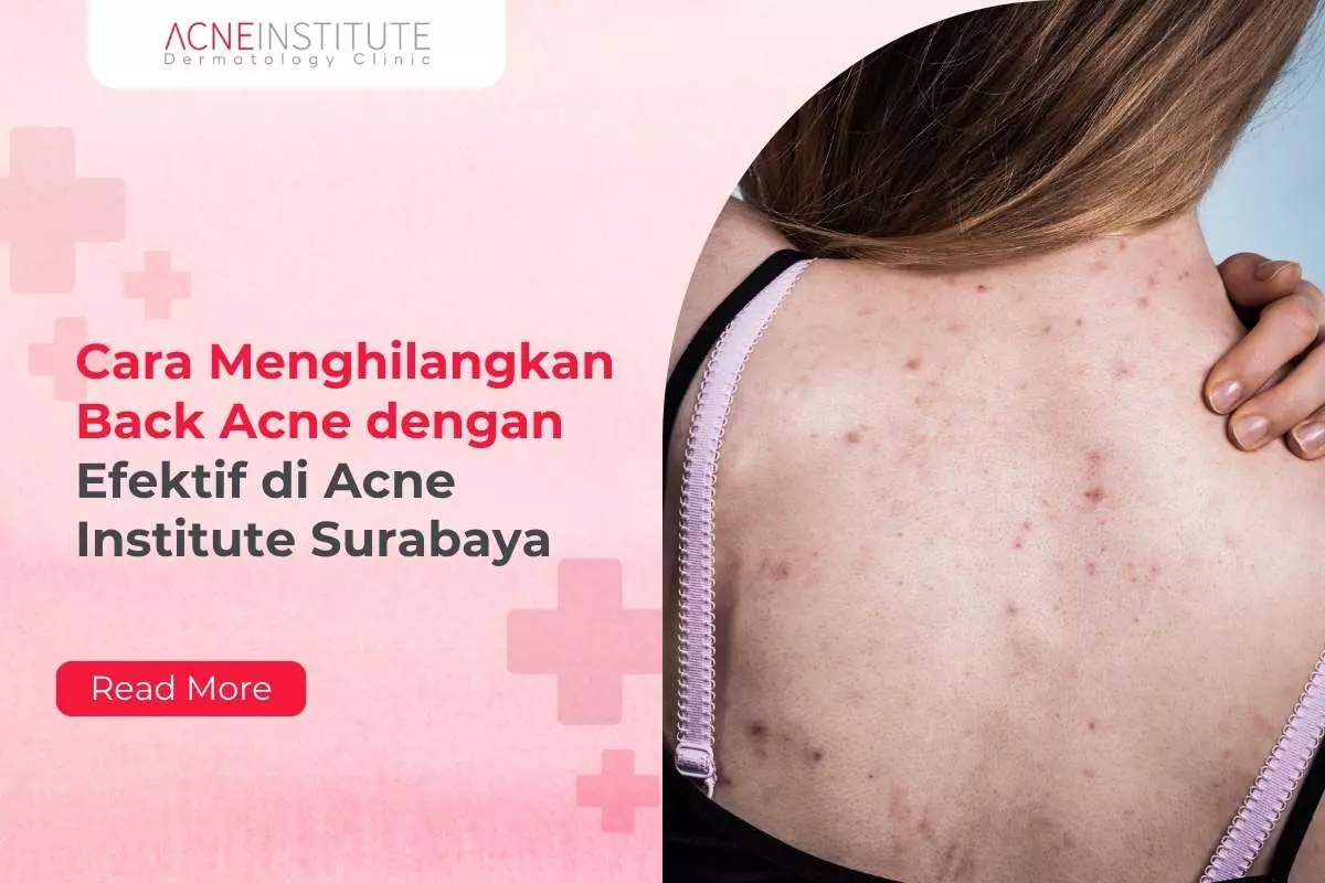 Cara Menghilangkan Back Acne dengan Efektif di Acne Institute Surabaya