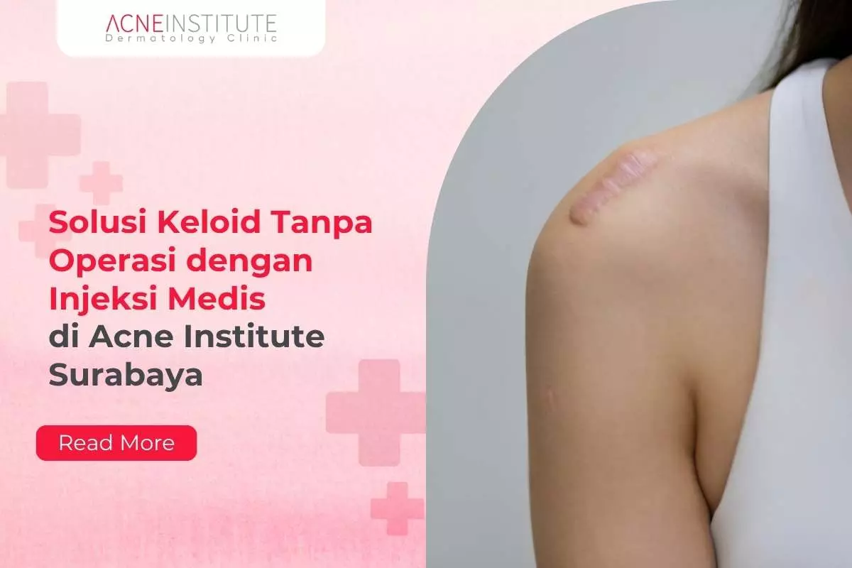 Solusi Keloid Tanpa Operasi dengan Injeksi Medis di Acne Institute Surabaya