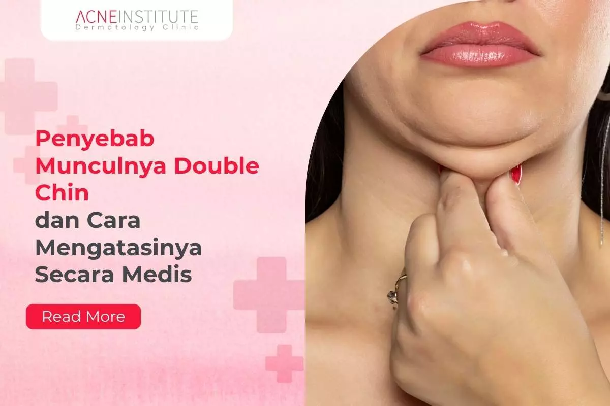 Penyebab Munculnya Double Chin dan Cara Mengatasinya Secara Medis