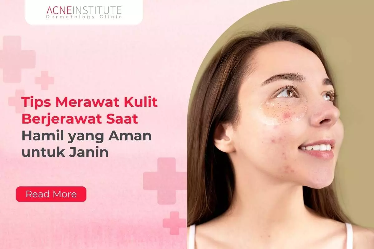 Tips Merawat Kulit Berjerawat Saat Hamil yang Aman untuk Janin