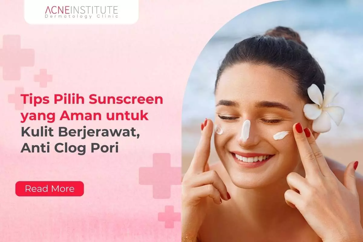 Tips Pilih Sunscreen yang Aman untuk Kulit Berjerawat, Anti Clog Pori
