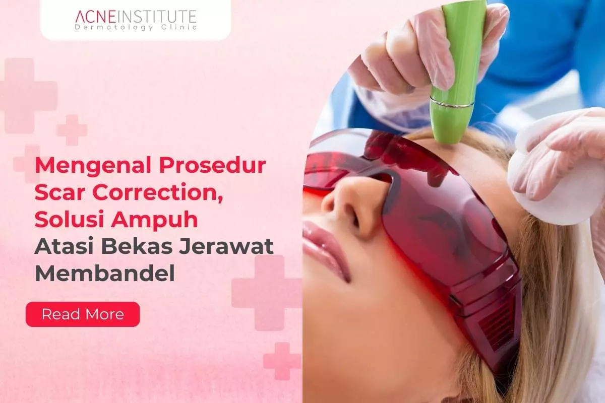 Mengenal Prosedur Scar Correction, Solusi Ampuh Atasi Bekas Jerawat Membandel
