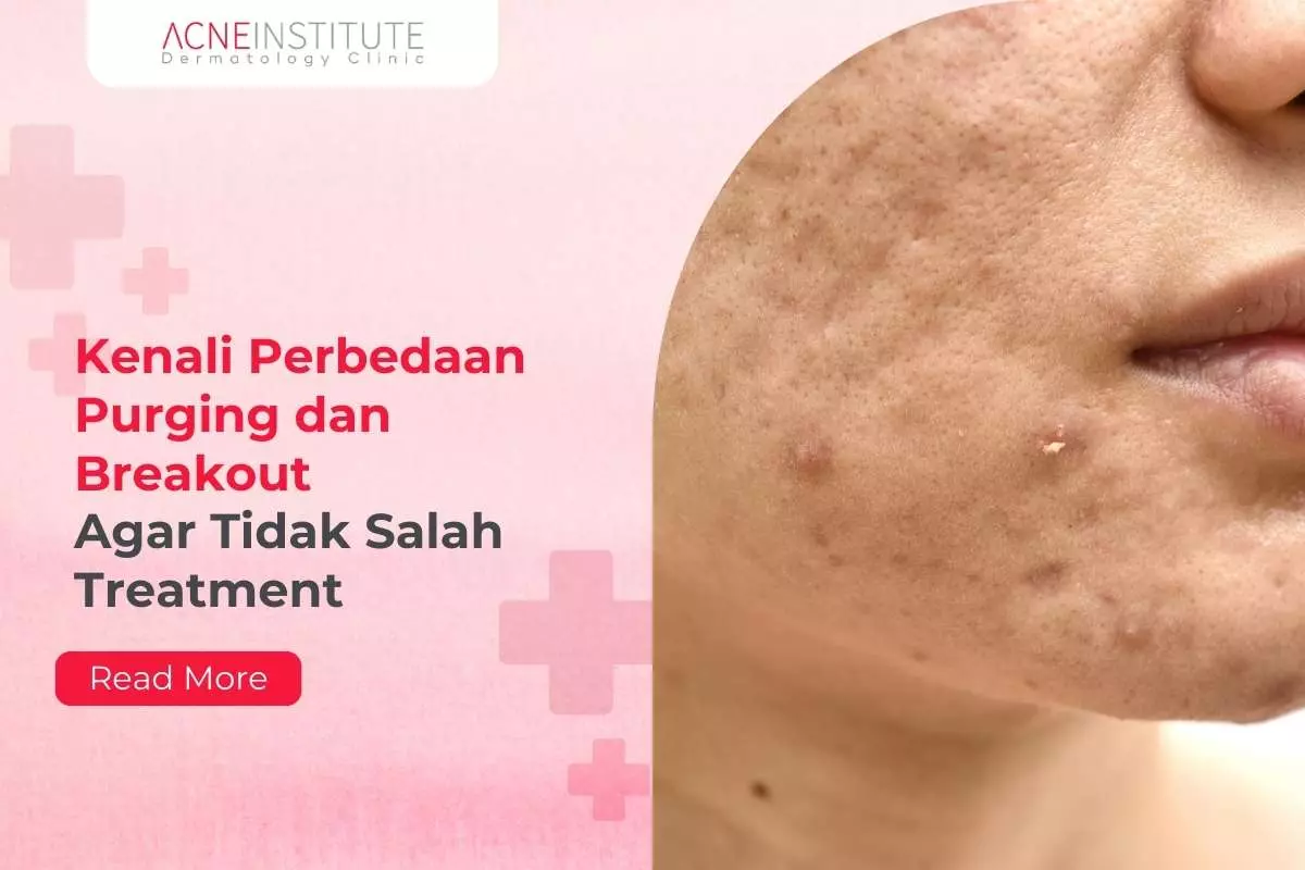 Kenali Perbedaan Purging dan Breakout Agar Tidak Salah Treatment