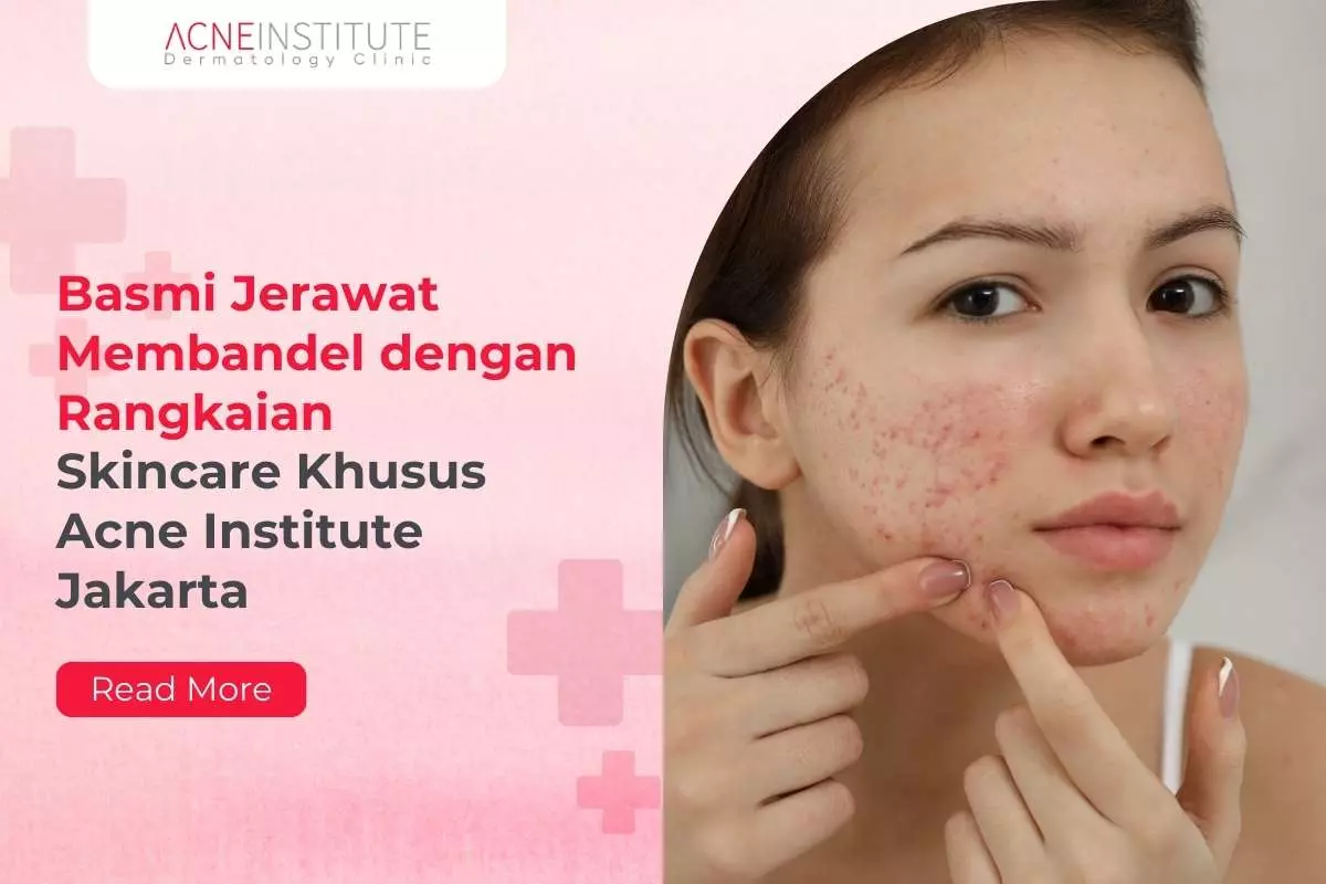 Basmi Jerawat Membandel dengan Rangkaian Skincare Khusus Acne Institute Jakarta