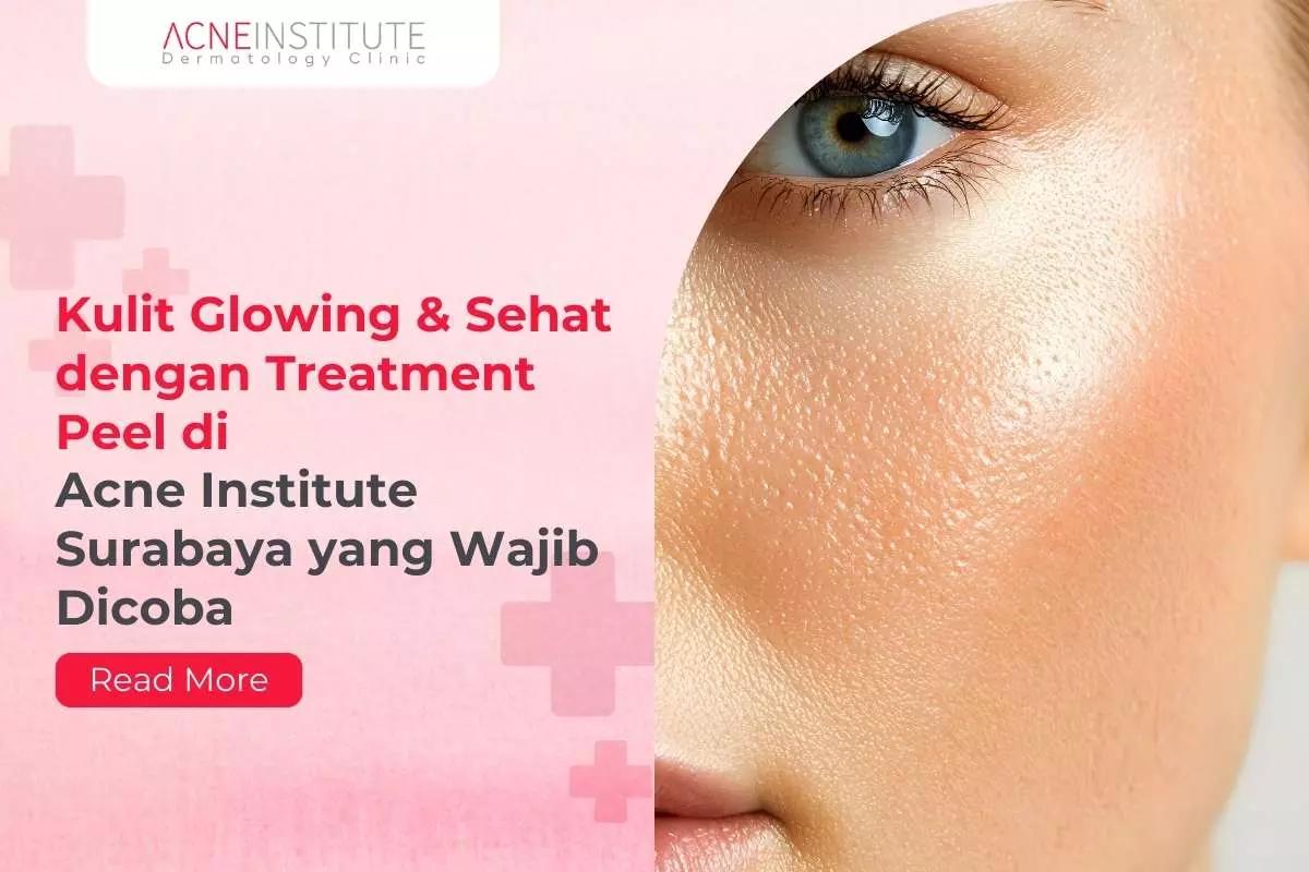Kulit Glowing & Sehat dengan Treatment Peel di Acne Institute Surabaya yang Wajib Dicoba