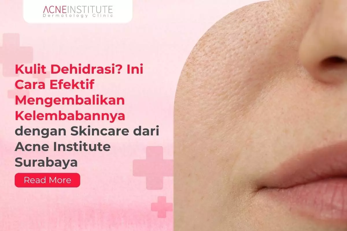 Kulit Dehidrasi? Ini Cara Efektif Mengembalikan Kelembabannya dengan Skincare dari Acne Institute Surabaya