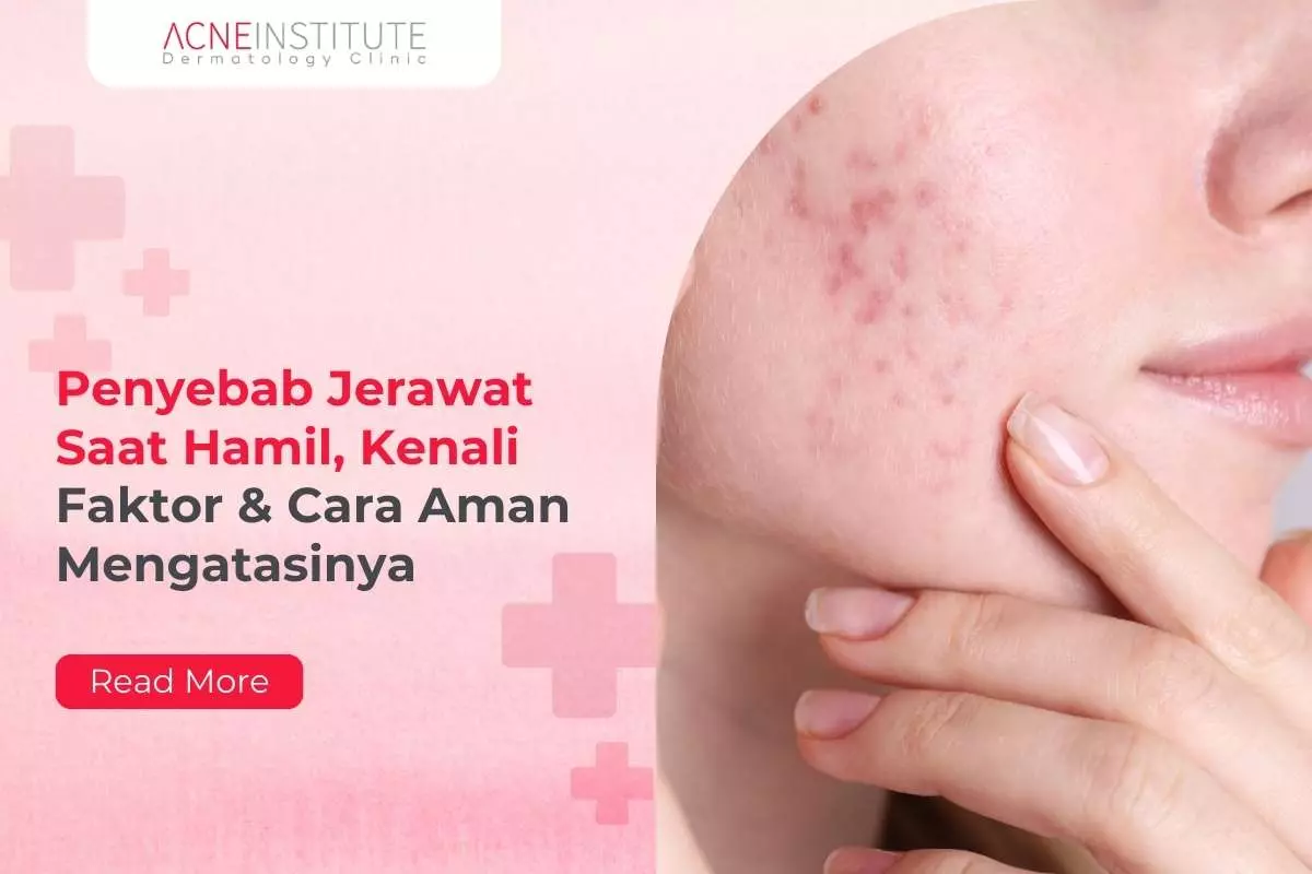 Penyebab Jerawat Saat Hamil, Kenali Faktor & Cara Aman Mengatasinya
