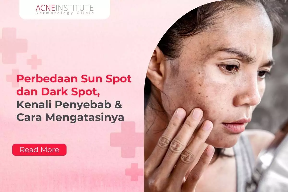 Perbedaan Sun Spot dan Dark Spot, Kenali Penyebab & Cara Mengatasinya