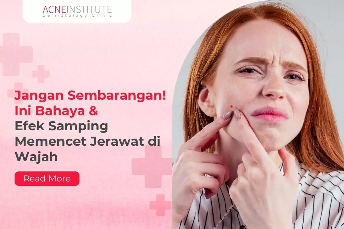 Jangan Sembarangan! Ini Bahaya & Efek Samping Memencet Jerawat di Wajah