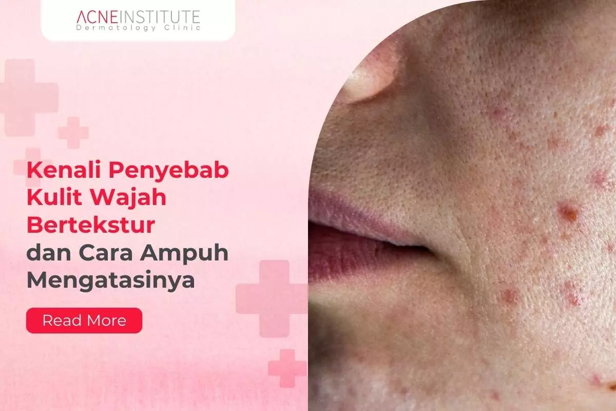 Kenali Penyebab Kulit Wajah Bertekstur dan Cara Ampuh Mengatasinya