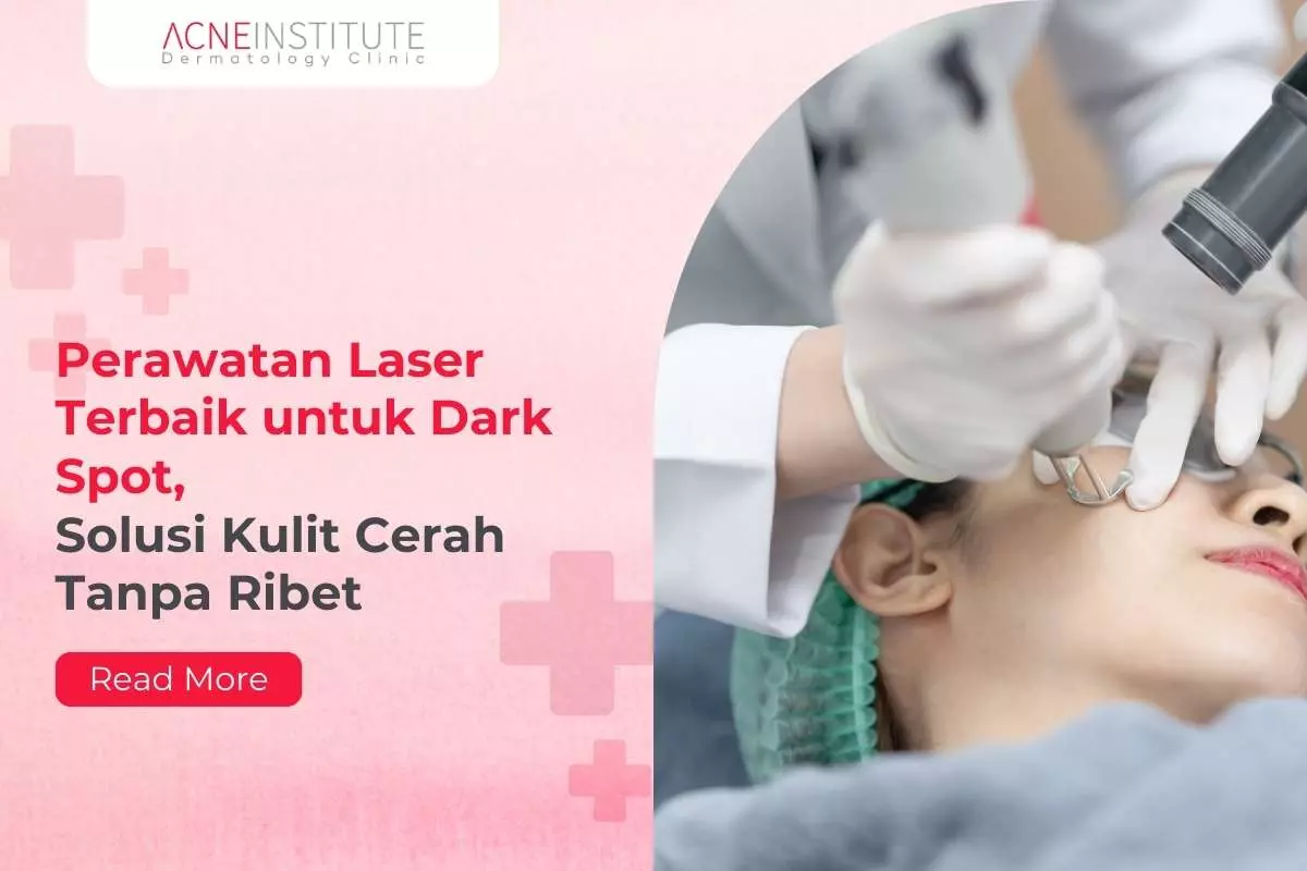 Perawatan Laser Terbaik untuk Dark Spot, Solusi Kulit Cerah Tanpa Ribet