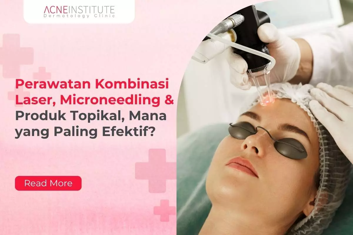 Perawatan Kombinasi Laser, Microneedling & Produk Topikal, Mana yang Paling Efektif?