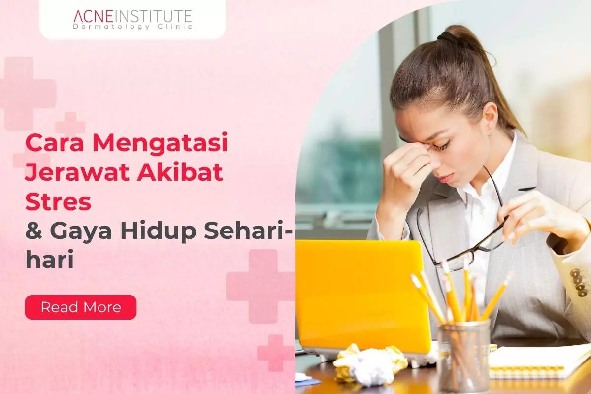 Cara Mengatasi Jerawat Akibat Stres & Gaya Hidup Sehari-hari